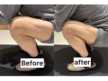 草加きらめき整骨院/膝痛/O脚/X足/骨盤矯正