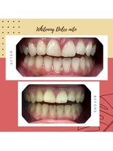 ドルチェ 水戸店(Dolce)/6来店コース　before&after★