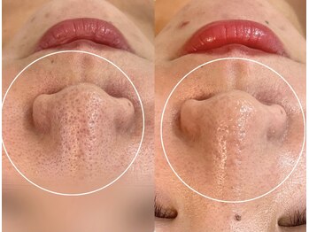 アンベリール(Embellir)/REVIピーリング♪