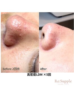 リサプリ(Re: Supple)/鎮静化◎皮脂分泌バランス整う