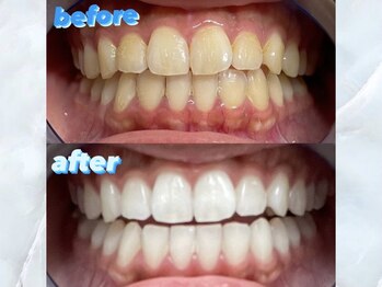 ライトケアサロン 銀座店(Light Care Salon)/セルフホワイトニングの症例写真