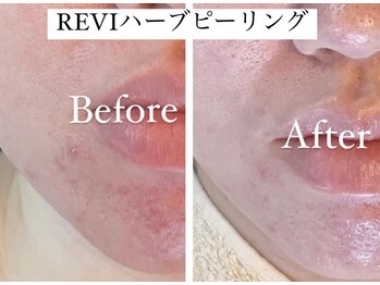 リフレ(Refre)/ニキビケアにハーブピーリング◎