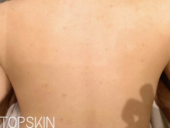 トップスキン 名駅(TOPSKIN)/肌質改善ハーブピーリング◎