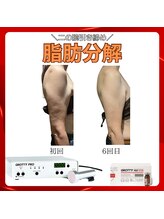 トータルビューティーサロン ヴィヴィエ(ViVier)/脂肪分解　二の腕症例6回