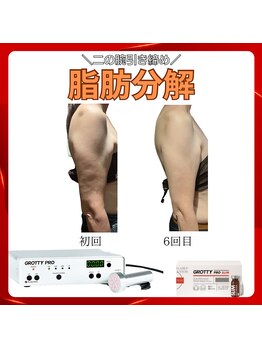 トータルビューティーサロン ヴィヴィエ(ViVier)/脂肪分解　二の腕症例6回