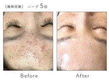 美肌研究所 東京新宿支店/フェイシャル症例　ぶつぶつ改善