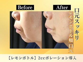 ポーベルポー(Peau Belle poe)/【レモンボトル】頬口元ポニョ肉