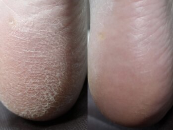 イリ(iri.)の写真/【フットケア/角質除去】ガサガサな足裏もふわふわ赤ちゃん肌に♪Footジェル、オフとの組み合わせもOK◎