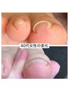 巻き爪ケア