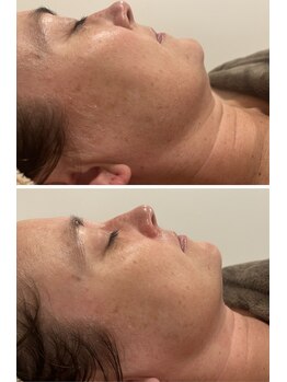 ビューティー アディクト(Beauty addict)/一度で小顔が手に入る！