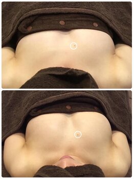 ソラ(sora)/バストアップ・バストケア症例★