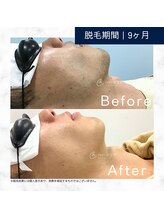 メンズクリア 上水戸ドンキ店/【メンズクリア】お客様の施術例