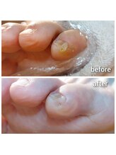 爪切り屋 足楽/小趾の魚の目