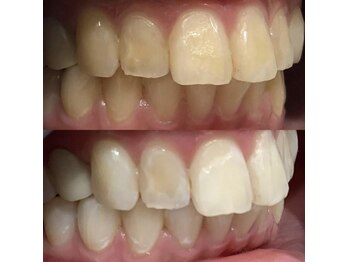 ハリス(HARIS)/セルフホワイトニング