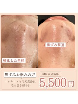 マヴィ くずは店(MavY.)/新MENU☆ニョキニョキ毛穴洗浄