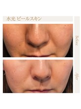 水光ピールスキン/水光ピーリングご利用で