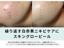 お顔ラボ AOYAMA(お顔LABO)/コメドや赤み、肌荒れに