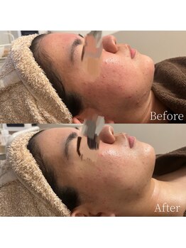 リリールア(Rere-Rua)/毛穴洗浄！