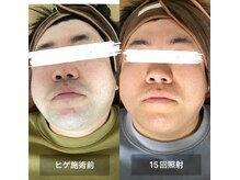 リリー(RILY)/【ビフォーアフター】