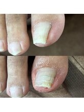 リリ(lili)/巻き爪矯正1回目（右親指）