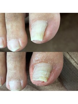 巻き爪矯正1回目（右親指）