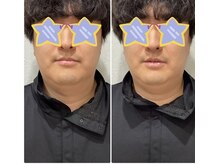 ラ フェリーチェ(La Felice)/高濃度水素酸素吸入before after