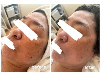 アリュール(Allule)/美白、シミシワコース