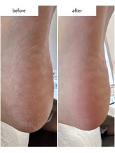 ケアプラス(care plus)/足裏角質ケア