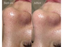 ポアラ(POARA)/毛穴/ワックス脱毛