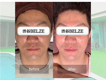 ベルゼ 渋谷店(BELZE)/ラジオ波フェイシャル