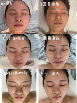 ルネ(Rune)/バクテリウムピール効果