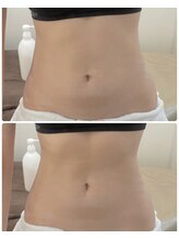 オプレア 千種店(OPREA)/【比較写真】ハイパーナイフ効果