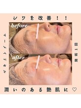 ピオニービューティー(Peony Beauty)/マーメイドセルトリートメント