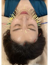 アキュティ 吉祥寺(Acuty)/電気を流す小顔美容鍼