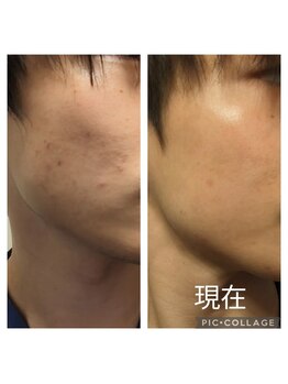 甲陽園鍼灸わたぐも/肌質改善