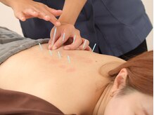 リム(Rim.)/鍼灸施術