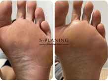 ロンディネ(Rondine)/足裏角質ケア