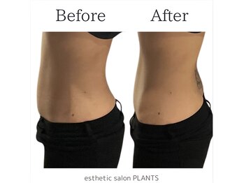 プランツ(PLANTS)/30代／お腹／１回