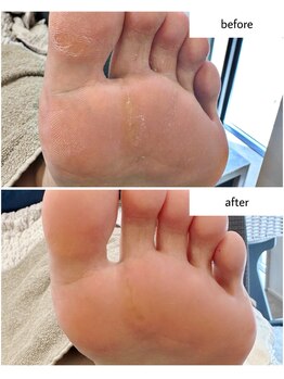 ケアプラス(care plus)/足裏角質ケア