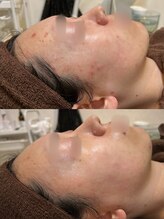 アンジェロ/【ニキビケア】肌育プログラム