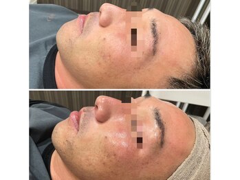 リリ(LiLi)/ビオフィート・ビフォーアフター