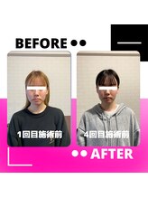 はりん美鍼灸/小顔矯正　before＆after　NO.2
