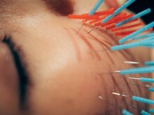 くすの樹接骨院 整体院 吉野ヶ里院/[美容鍼/鍼灸]リフトアップ/小顔