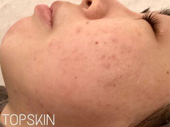 トップスキン 名駅(TOPSKIN)/肌質改善・肌管理はTOPSKINへ♪