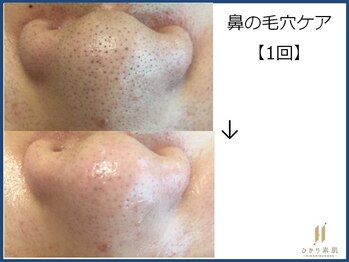 ひかり素肌/お鼻ケア １回