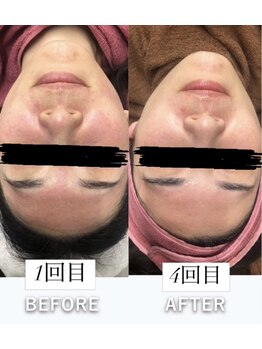 レチカ(Rechica)/微細針エイジング美肌術