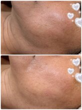 プルメリスタ 八千代緑が丘店/光フェイシャル(施術１回)