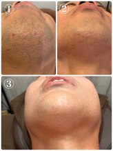 ミランオオサカ(MIRAN OSAKA)/ヒゲ メンズ脱毛 心斎橋