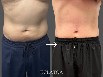 【次世代脂肪冷却・小顔ハイリフト専門店】ECLATOA　四日市/痩身/ダイエットの写真/【結果重視】1回で違いを実感！四日市で本気のダイエットを叶える次世代・脂肪冷却×キャビ×EMS痩身！