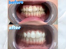 ライトケアサロン 銀座店(Light Care Salon)/セルフホワイトニングの症例写真